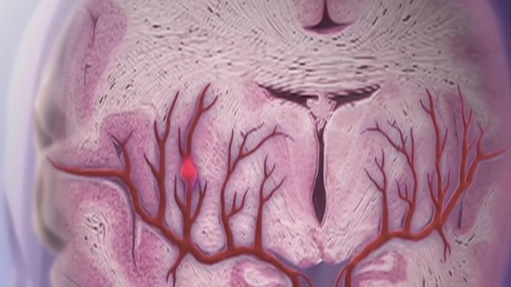 Knowing the signs of a stroke can save lives — Alpharetta Community news